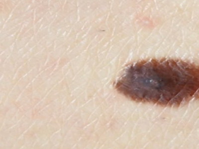 Besplatni dermatološki pregledi